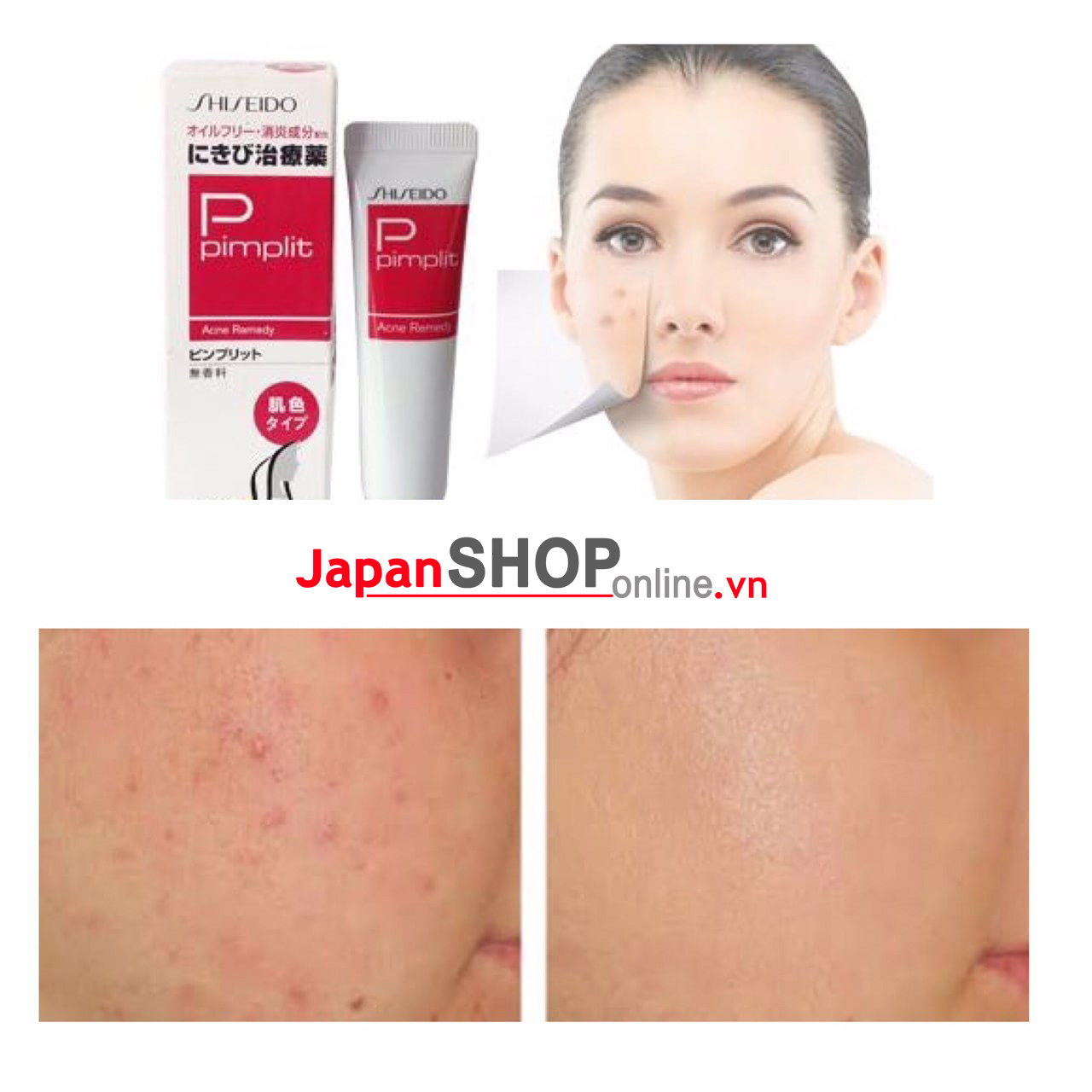 Kem Trị Mụn Shiseido Pimplit 18g Nhật Bản